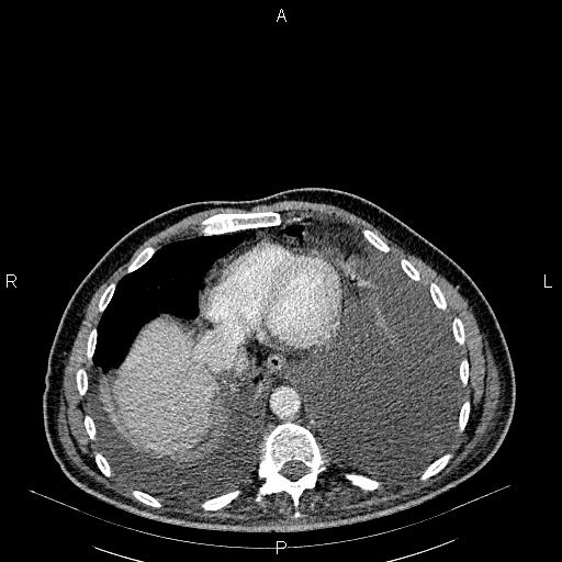File:Non Hodgkin lymphoma in a patient with ankylosing spondylitis (Radiopaedia 84323-99621 B 25).jpg