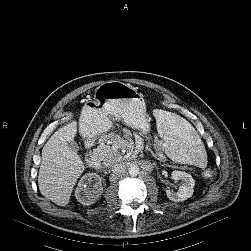 File:Non Hodgkin lymphoma in a patient with ankylosing spondylitis (Radiopaedia 84323-99621 B 38).jpg