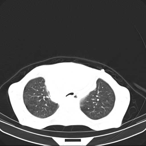 File:Non hodgkin lymphoma of the mediastinum (Radiopaedia 20814-20729 Axial lung window 15).jpg