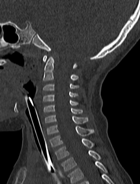 Normal CT cervical spine - pediatric (Radiopaedia 52549-58462 Sagittal bone window 104).jpg