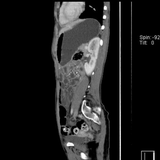 Normal CT enterography (Radiopaedia 30357-31000 D 17).jpg