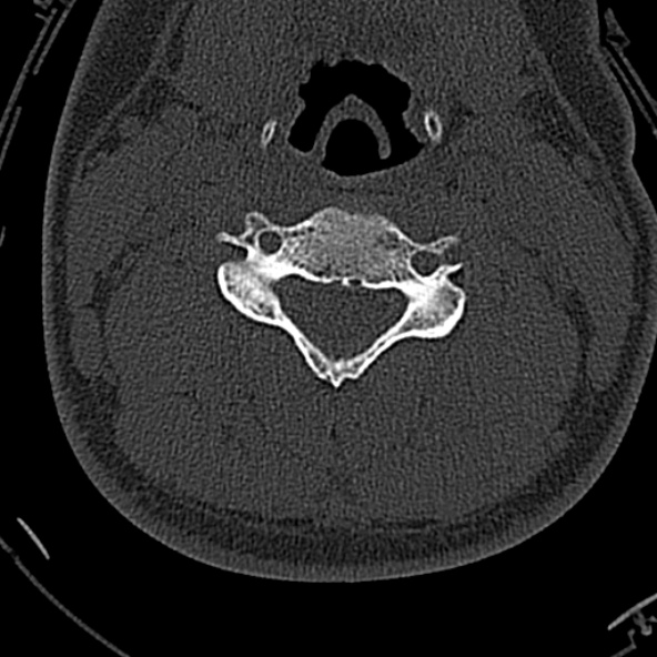 Normal CT of the cervical spine (Radiopaedia 53322-59305 Axial bone window 134).jpg