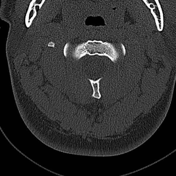 File:Normal CT of the cervical spine (Radiopaedia 53322-59305 Axial bone window 73).jpg
