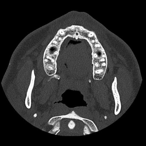 Normal CT paranasal sinuses (Radiopaedia 42286-45390 Axial bone window 99).jpg