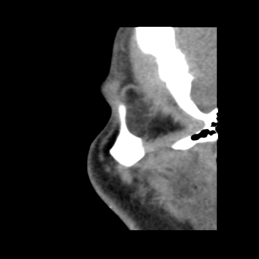 Normal CT paranasal sinuses (Radiopaedia 42286-45390 F 19).jpg