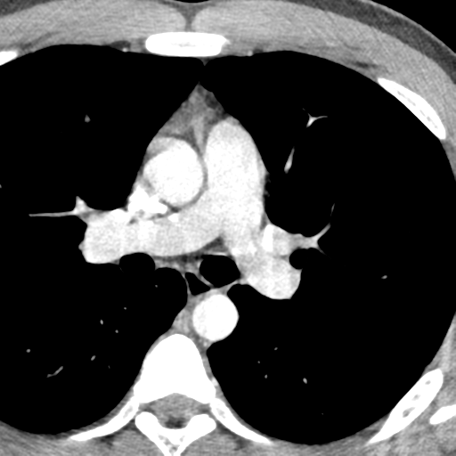 File:Normal CT pulmonary veins (pre RF ablation) (Radiopaedia 41748-44702 A 78).png
