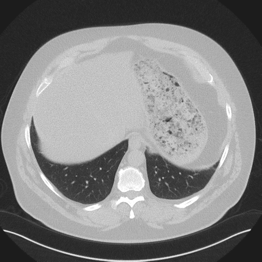 Normal HRCT (Radiopaedia 40797-43458 Axial lung window 48).png