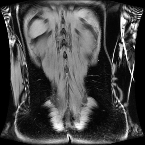 Normal MRI abdomen in pregnancy (Radiopaedia 88001-104541 M 118).jpg
