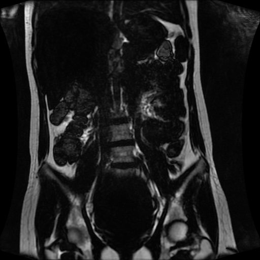 Normal MRI abdomen in pregnancy (Radiopaedia 88001-104541 N 77).jpg