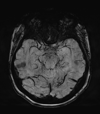 Normal MRI internal auditory canal (Radiopaedia 41613-44525 Axial SWI MIP 29).png