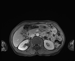 Normal adrenal glands MRI (Radiopaedia 82017-96004 M 39).jpg