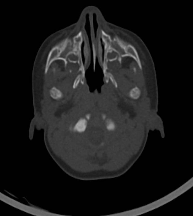 Normal brain CT - 2-month-old (Radiopaedia 53369-59350 Axial bone window 55).jpg