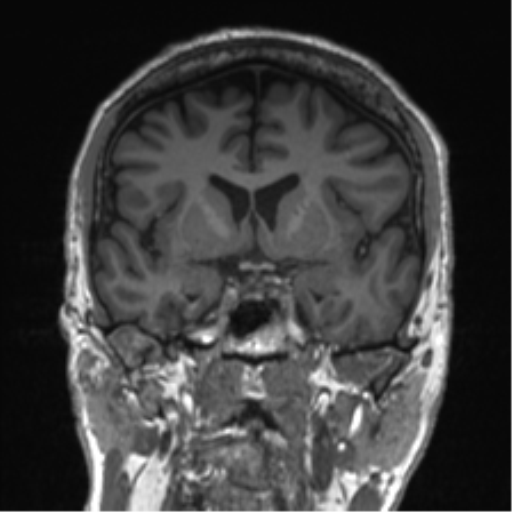 Normal brain MRI (non-focal epilepsy protocol) (Radiopaedia 53917-60040 Coronal T1 41).png