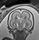 Normal brain fetal MRI - 22 weeks (Radiopaedia 50623-56050 Coronal T2 Haste 11).jpg
