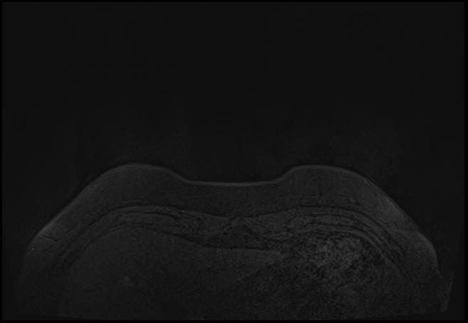 File:Normal breast MRI - dense breasts (Radiopaedia 80454-93850 Axial T1 3).jpg