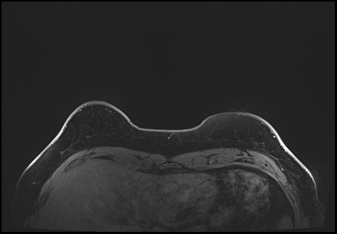 Normal breast MRI - dense breasts (Radiopaedia 80454-93850 C 20).jpg