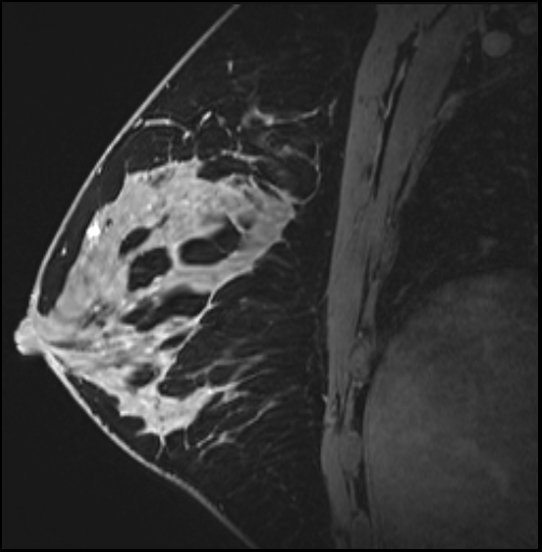 Normal breast MRI - dense breasts (Radiopaedia 80454-93850 I 108).jpg