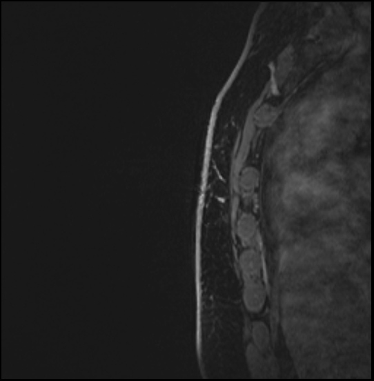 Normal breast MRI - dense breasts (Radiopaedia 80454-93850 I 169).jpg