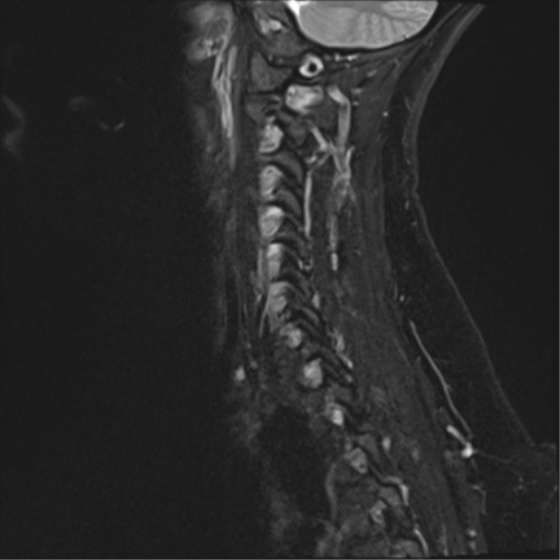 File:Normal cervical spine MRI (including Dixon) (Radiopaedia 42762-45925 Dixon- Water 13).png