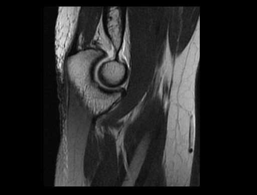 File:Normal elbow arthrograms (Radiopaedia 75550-86805 Sagittal PD 25).jpg