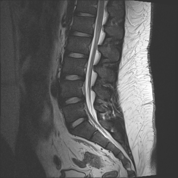 File:Normal lumbar spine MRI (Radiopaedia 47857-52609 Sagittal T2 10).jpg