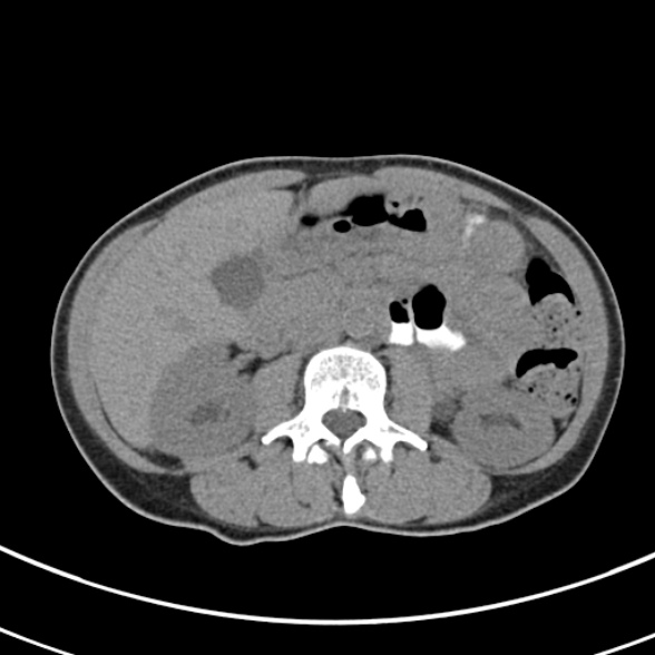 File:Normal multiphase CT liver (Radiopaedia 38026-39996 Axial non-contrast 35).jpg