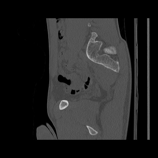 Normal pelvis (Radiopaedia 51473-57238 Sagittal bone window 56).jpg