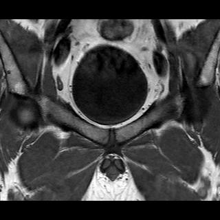 File:Normal prostate (MRI) (Radiopaedia 29986-30535 Coronal T1 2).jpg
