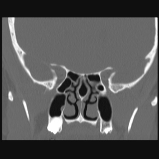 Normal sinus CT (annotated) (Radiopaedia 78917-91810 Coronal bone window 37).jpg