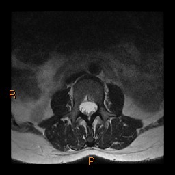 File:Normal spine MRI (Radiopaedia 77323-89408 Axial T2 3).jpg