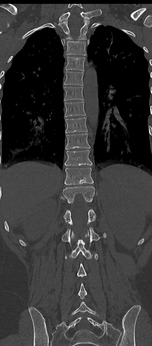 Normal thoracolumbar spine (Radiopaedia 43822-47309 Coronal bone window 58).png