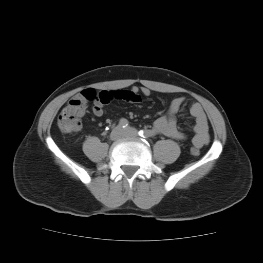 File:Obstructed kidney with perinephric urinoma (Radiopaedia 26889-27067 Axial non-contrast 4).jpg