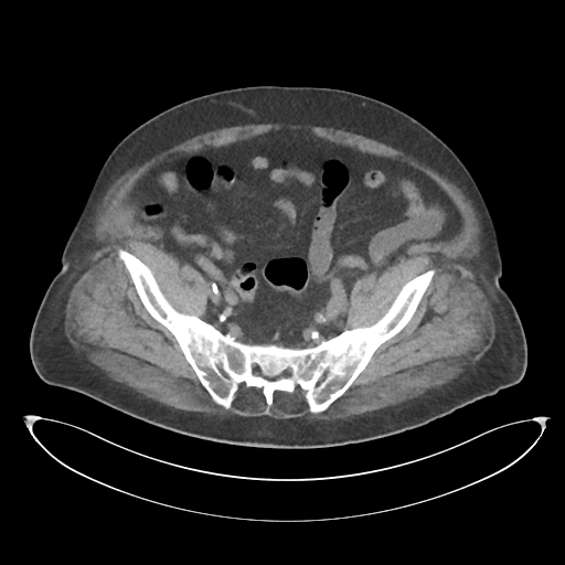 File:Obstructive pyelonephritis (Radiopaedia 46411-50844 Axial non-contrast 62).png