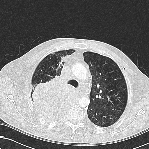 File:Obstructive superior vena cava tumor thrombus (Radiopaedia 28046-28306 Axial lung window 18).jpg