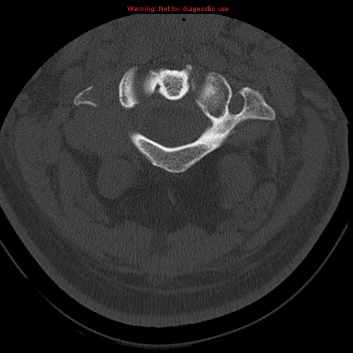 File:Occipital condyle fracture (Radiopaedia 18366-18208 Axial bone window 20).jpg