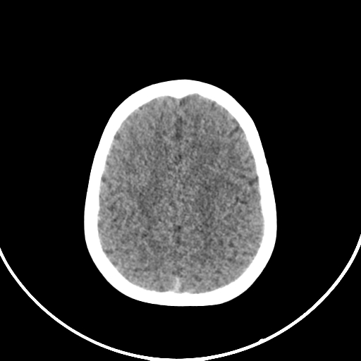 Occipital encephalocele (Radiopaedia 87339-103636 Axial non-contrast 66).jpg