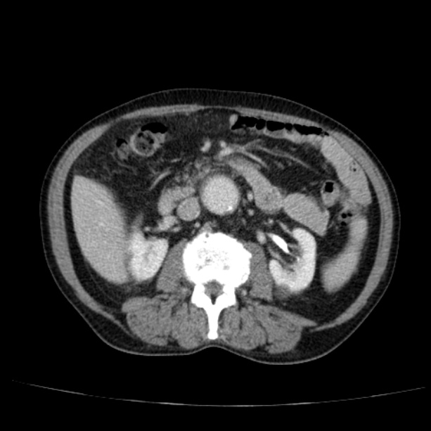 Abdominal aortic aneurysm (Radiopaedia 29248-29660 Axial C+ portal venous phase 27).jpg