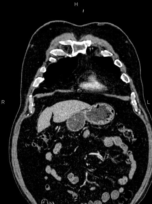 Abdominal aortic aneurysm (Radiopaedia 83094-97462 Coronal renal cortical phase 24).jpg