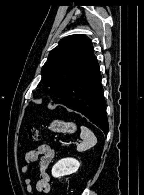 Abdominal aortic aneurysm (Radiopaedia 83094-97462 Sagittal renal cortical phase 100).jpg