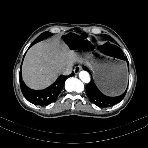 Abdominal aortic aneurysm (Radiopaedia 83581-98689 Axial C+ arterial phase 18).jpg