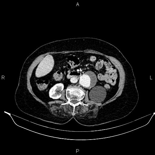 File:Abdominal aortic aneurysm (Radiopaedia 85063-100606 Axial C+ portal venous phase 40).jpg