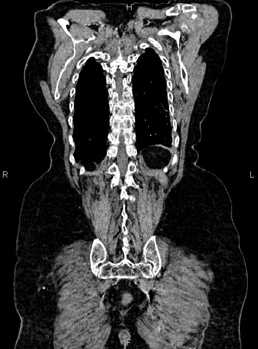 Abdominal aortic aneurysm (Radiopaedia 85063-100606 Coronal C+ arterial phase 52).jpg