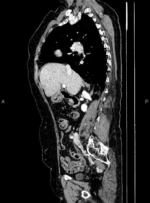 Abdominal aortic aneurysm (Radiopaedia 85063-100606 Sagittal C+ arterial phase 29).jpg
