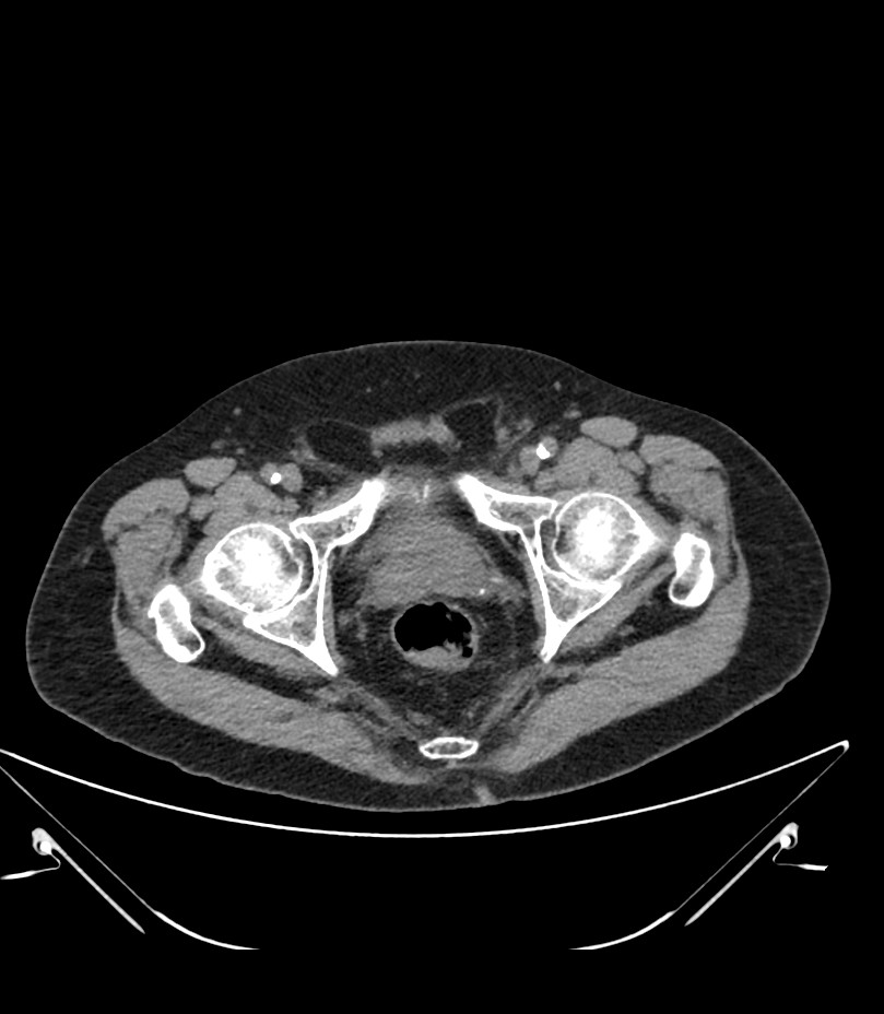 Abdominal aortic aneurysm with thrombus fissuration (Radiopaedia 46218-50618 Axial non-contrast 56).jpg
