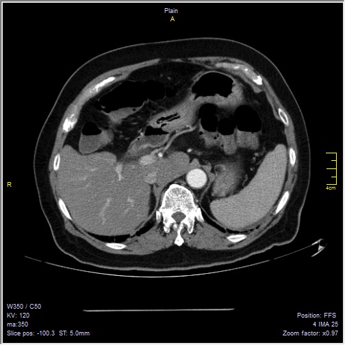 Abdominal aortic aneurysm with thrombus fissuration (Radiopaedia 47340-51926 Axial C+ arterial phase 9).jpg