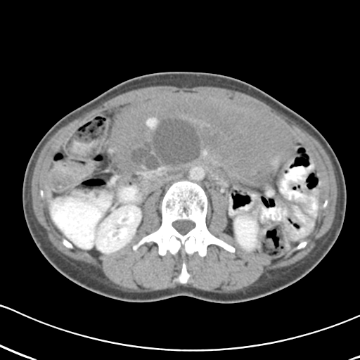 Abdominal desmoid tumor (Radiopaedia 41007-43740 Axial C+ portal venous phase 29).png