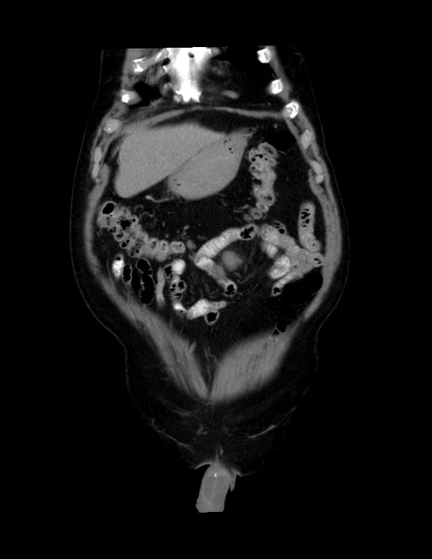 Abdominal lymphoma - with sandwich sign (Radiopaedia 53486-59492 C+ portal venous phase 49).jpg
