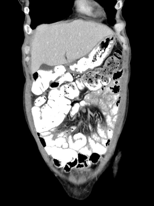 Abdominal wall and retroperitoneal tuberculosis (Radiopaedia 88137-104729 Coronal C+ portal venous phase 23).jpg