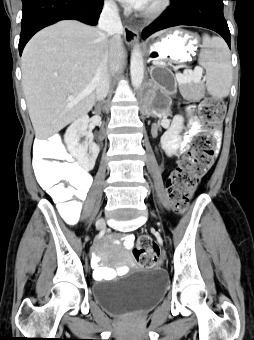 Abdominal wall and retroperitoneal tuberculosis (Radiopaedia 88137-104729 Coronal C+ portal venous phase 58).jpg