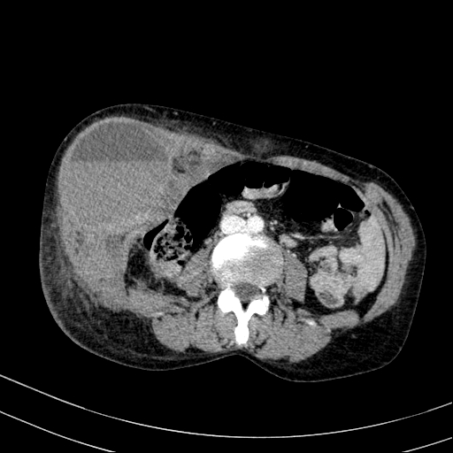Abdominal wall hematoma with active bleeding (Radiopaedia 83915-99117 Axial C+ portal venous phase 52).jpg